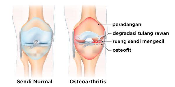 Osteobike Device